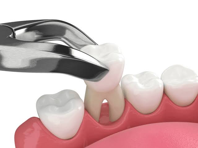 Comfortable Tooth Extraction